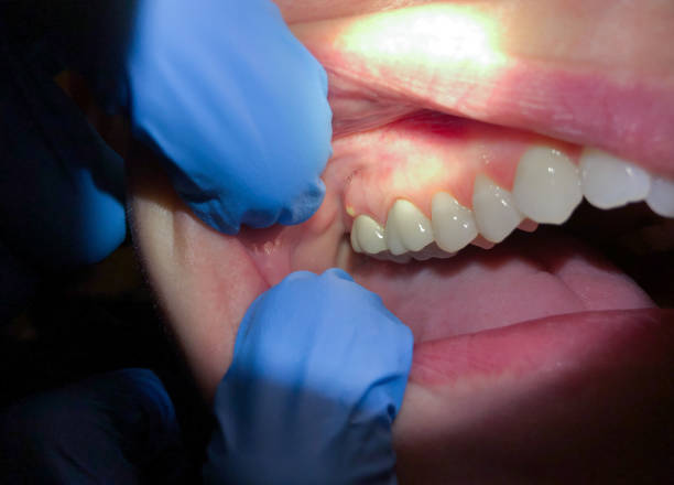 Best Emergency Root Canal Treatment in Kekoskee, WI